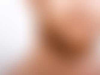 Does Beard Hair Transplant Work for a Scarred Beard Line