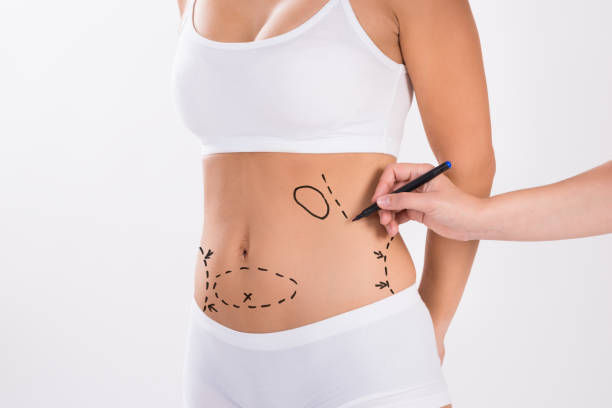 Can a Tummy Tuck Improve Overall Body Shape and Balance