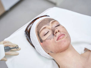 Is Laser Carbon Peel Effective for Acne Scars