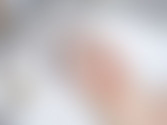 Is Laser Carbon Peel Effective for Acne Scars