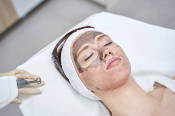 Is Laser Carbon Peel a Smart Choice for Post-Acne Skin Care