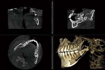 歯科用CT 3D画像診断