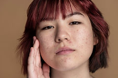 What Causes Blackhead Pores and 7 Common Approaches to Help Manage Them
