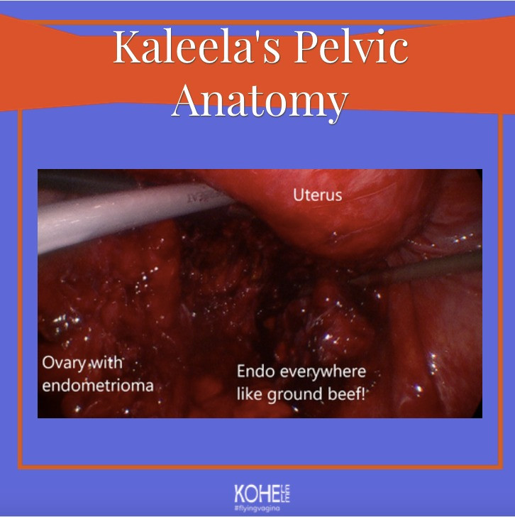 Kaleela's Pelvic Anatomy