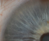 אבחון דרך העין אירידלוגיה לאטופיק דרמטיטיס