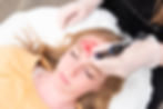 Client undergoing microneedling treatment at O Esthetics, with professional using a precision device to boost collagen and im