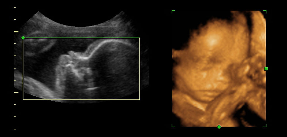 3D Ultrasound Image