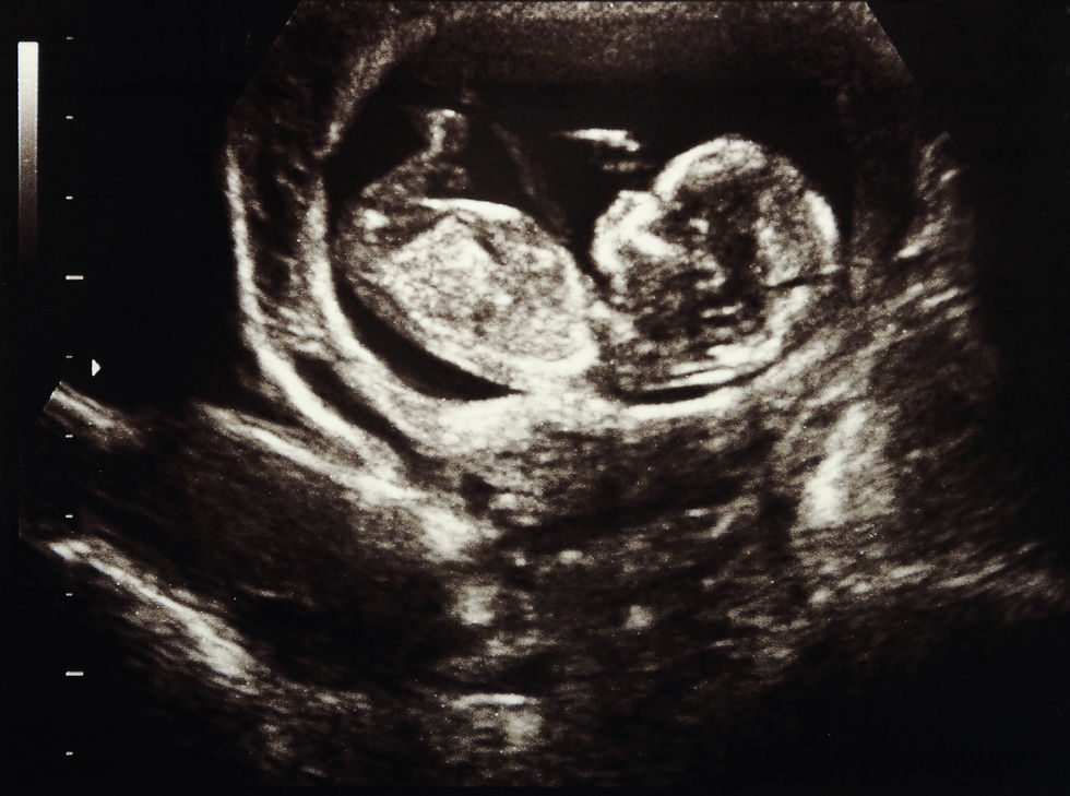 2d Sneak Peek Ultrasound Image
