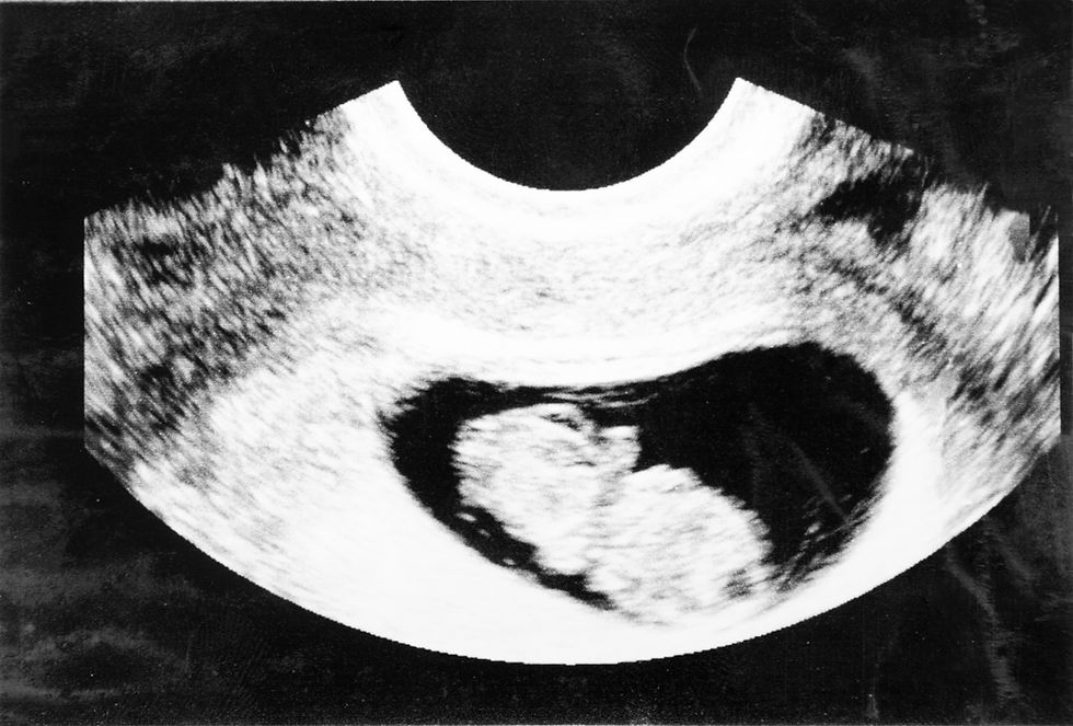 Early Peanut Sneak Peek Ultrasound