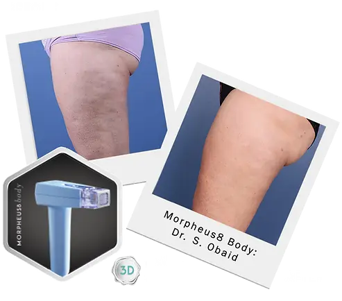 before_after_results_body_3d_morpheus_8_dunwoody_wellness.webp