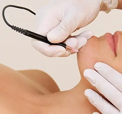 Everything-You-Need-to-Know-Before-You-Get-Electrolysis-Hair-Removal-4.webp