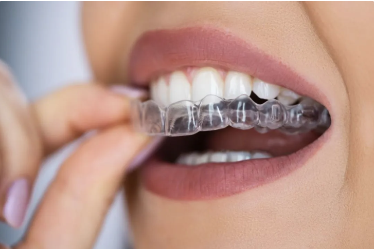 clear aligners.png