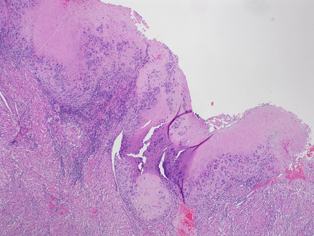 GYN Case 2. Hysterectomy from a young patient in 20s