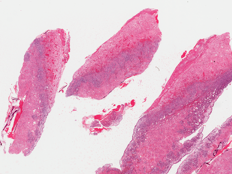 ENT Case 8. Sinonasal endoscopic surgery from a diabetic patient.