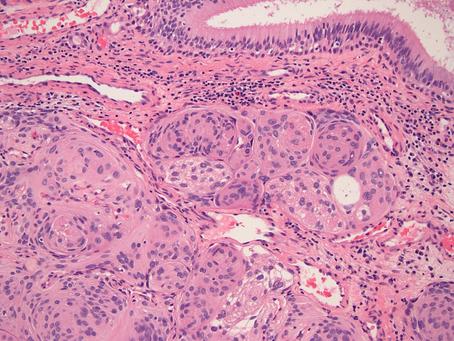 ENT Case 7. Nasal cavity mass from a middle-aged male patient.