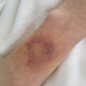 Bruise (멍)