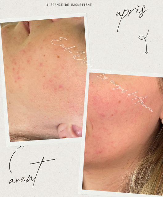 acne.PNG