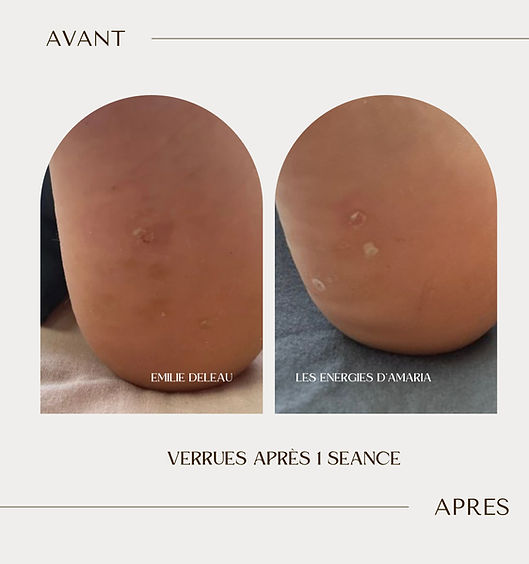 avant-après emilie Deleau magnétiseuse Bourgbarré rennes bretagne