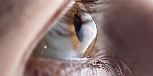 Keratoconus.jpg
