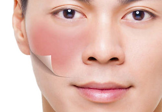 rosacea.jpg