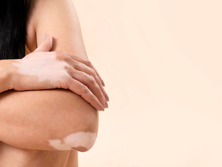 A woman with vitiligo patches on her hand and elbow