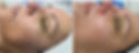 Aquafirm Facial B & A_edited.jpg