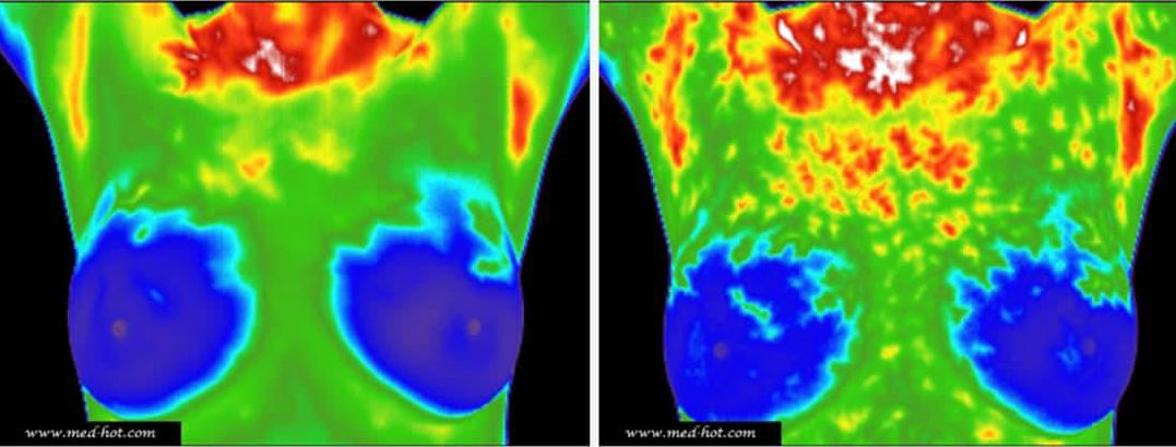 thermography-services-breast-scan.jpg