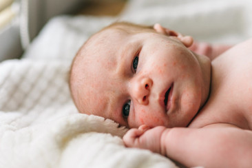 COS’È L’ACNE NEONATALE