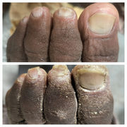 advance medi pedicure