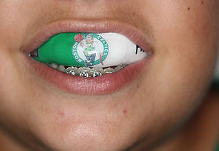 Protetor bucal com detalhes personalizados, exemplificando inovação e conforto na odontologia esportiva.