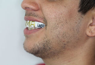 Protetor bucal colorido com design vibrante, destacando estilo e funcionalidade para esportistas.