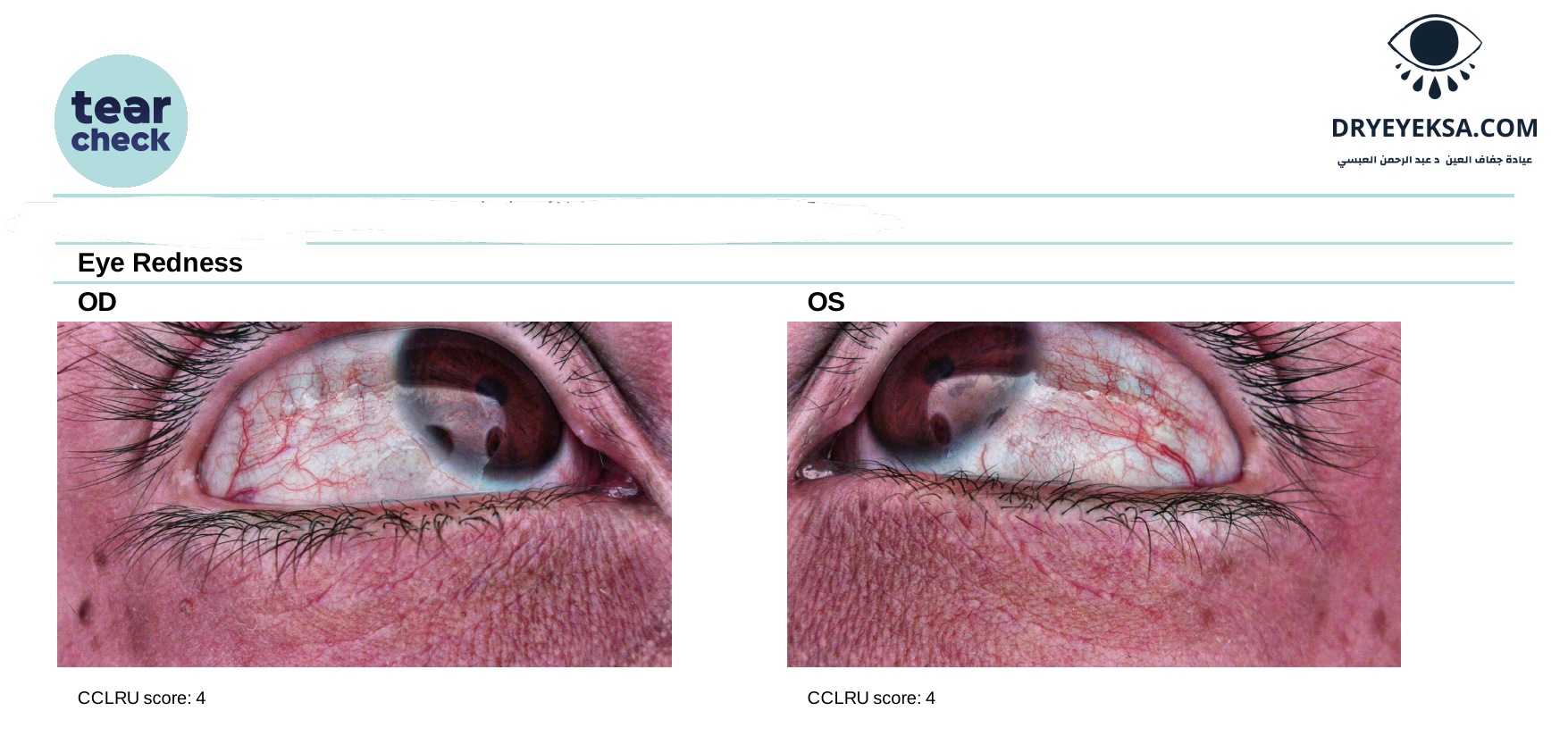 eye-redness-example-dryeyeksa.jpg