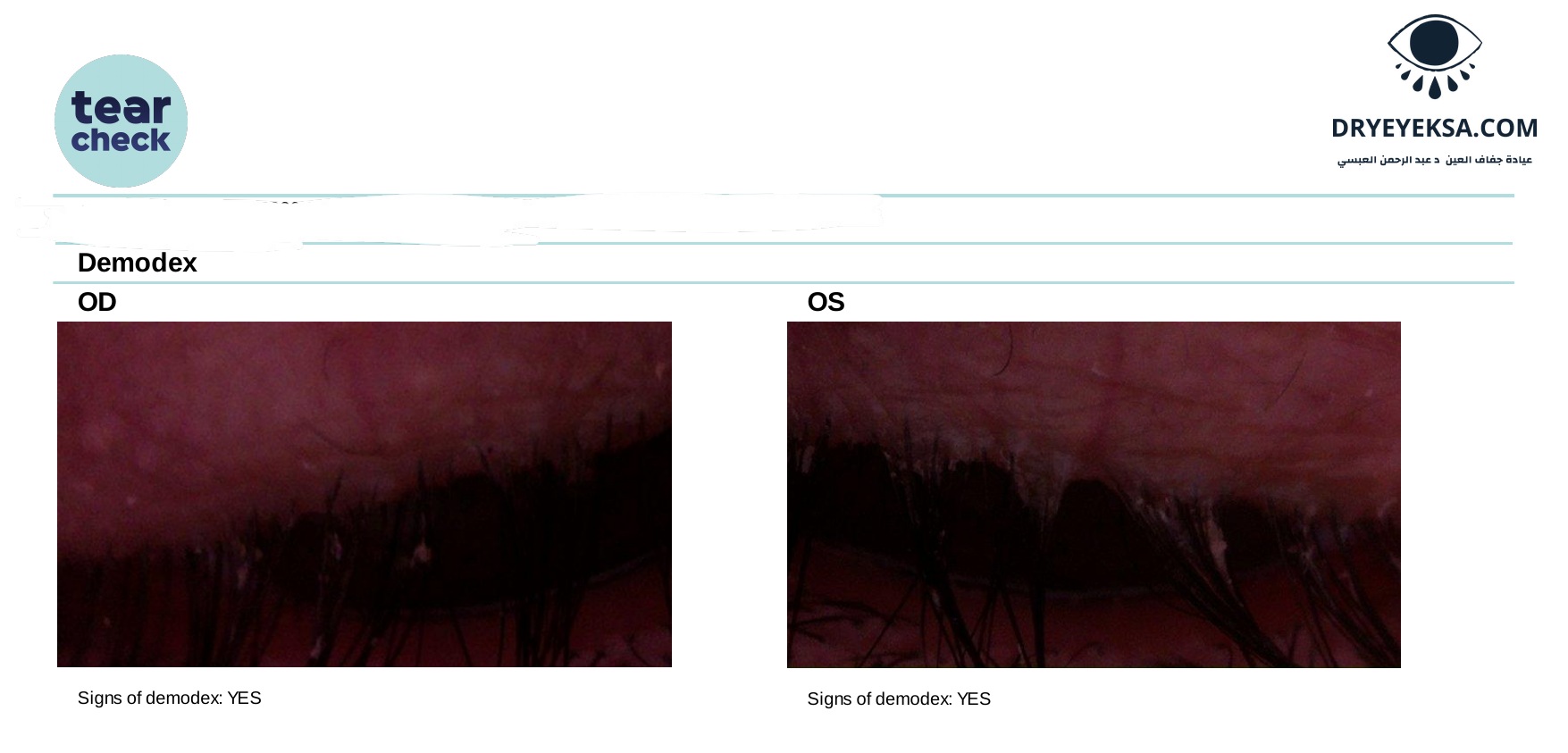 demodex-example-1-dryeyeksa.jpg