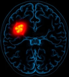 Figure 4: Brain with tumor