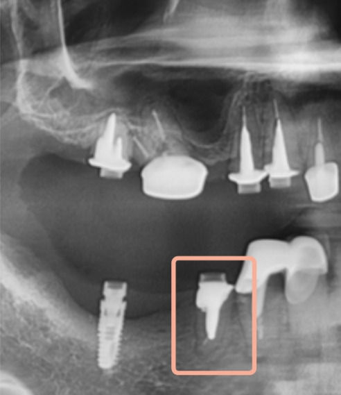 框線內為應用Fasten Keyway for Natural teeth的牙位