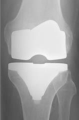 Radiografiaprotese.png