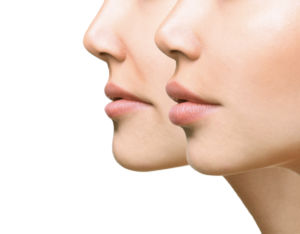 FILLERS