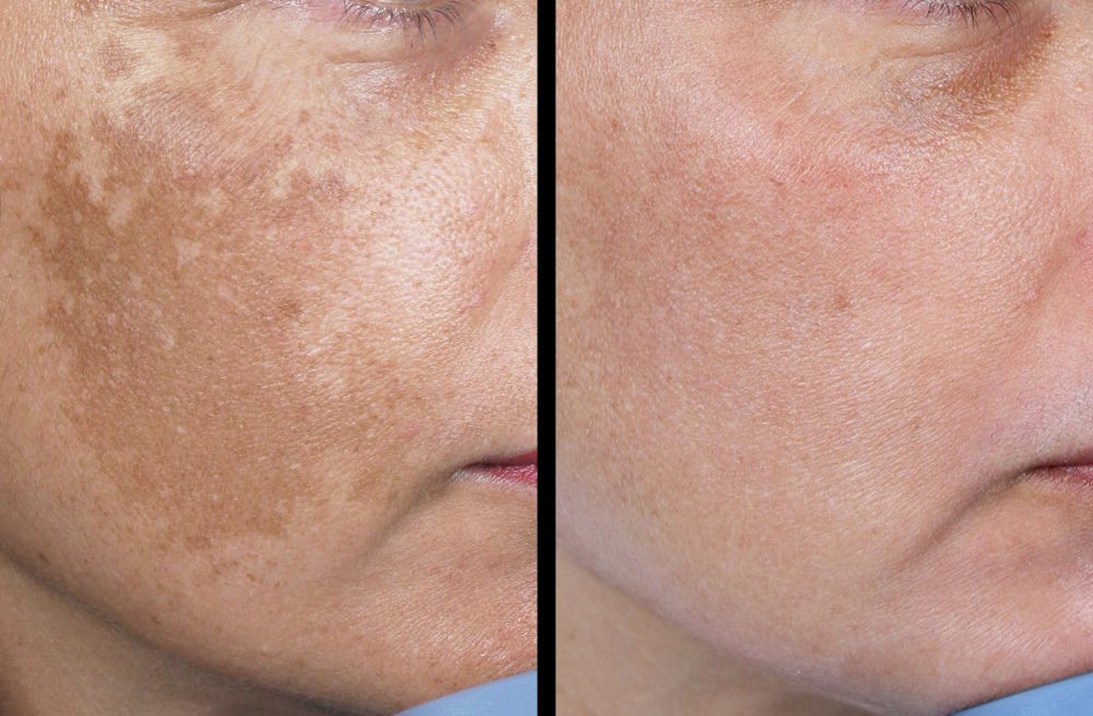 Luminosity facial treatment imagery