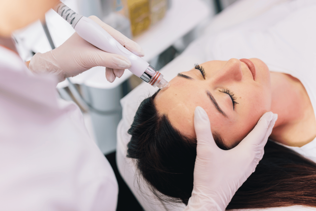 Professional microneedling treatment