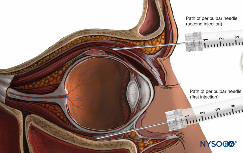 3 Easy Locoregional Techniques You May Not Know