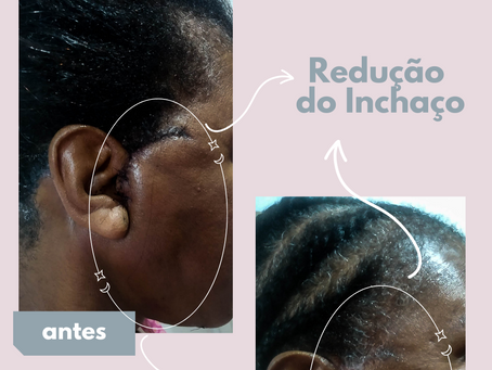 Drenagem Linfática Pós-Operatório