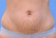 Puku Stretch Marks.jpg