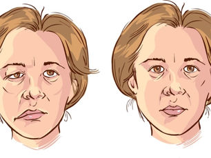 Parálisis Facial (de Bell) ¿Por qué ocurre?