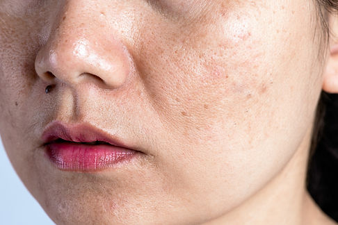 woman-with-problematic-skin-acne-scars-wrinkles-dark-spots.jpg
