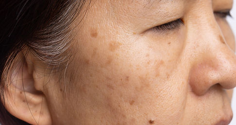 menopausal-women-worry-about-melasma-face.jpg
