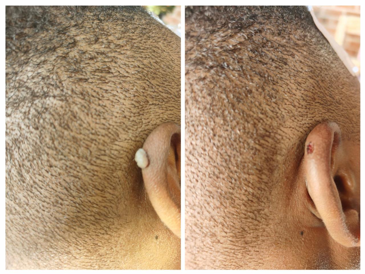 Skin tag before and after removal