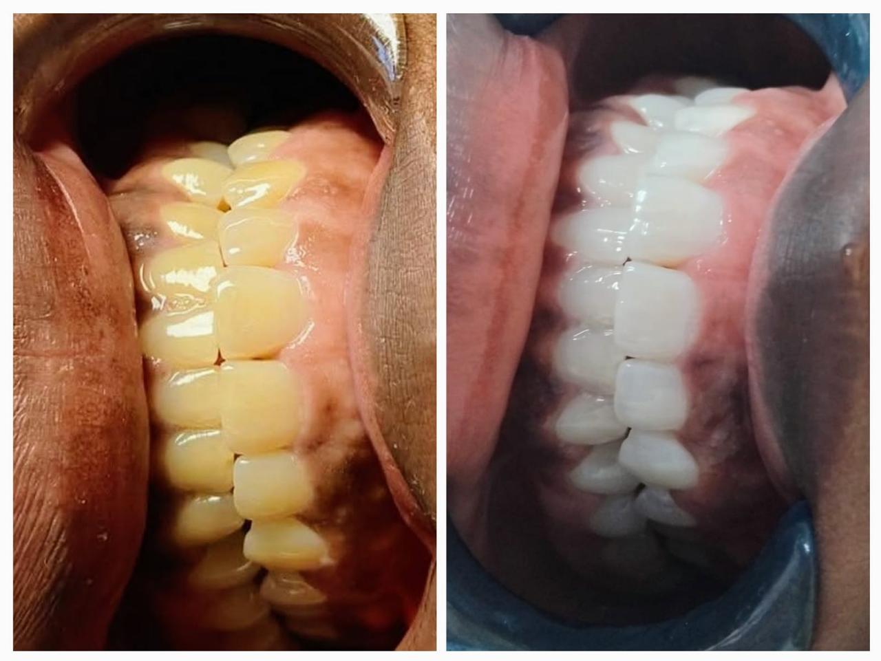 Teeth before and after whitening