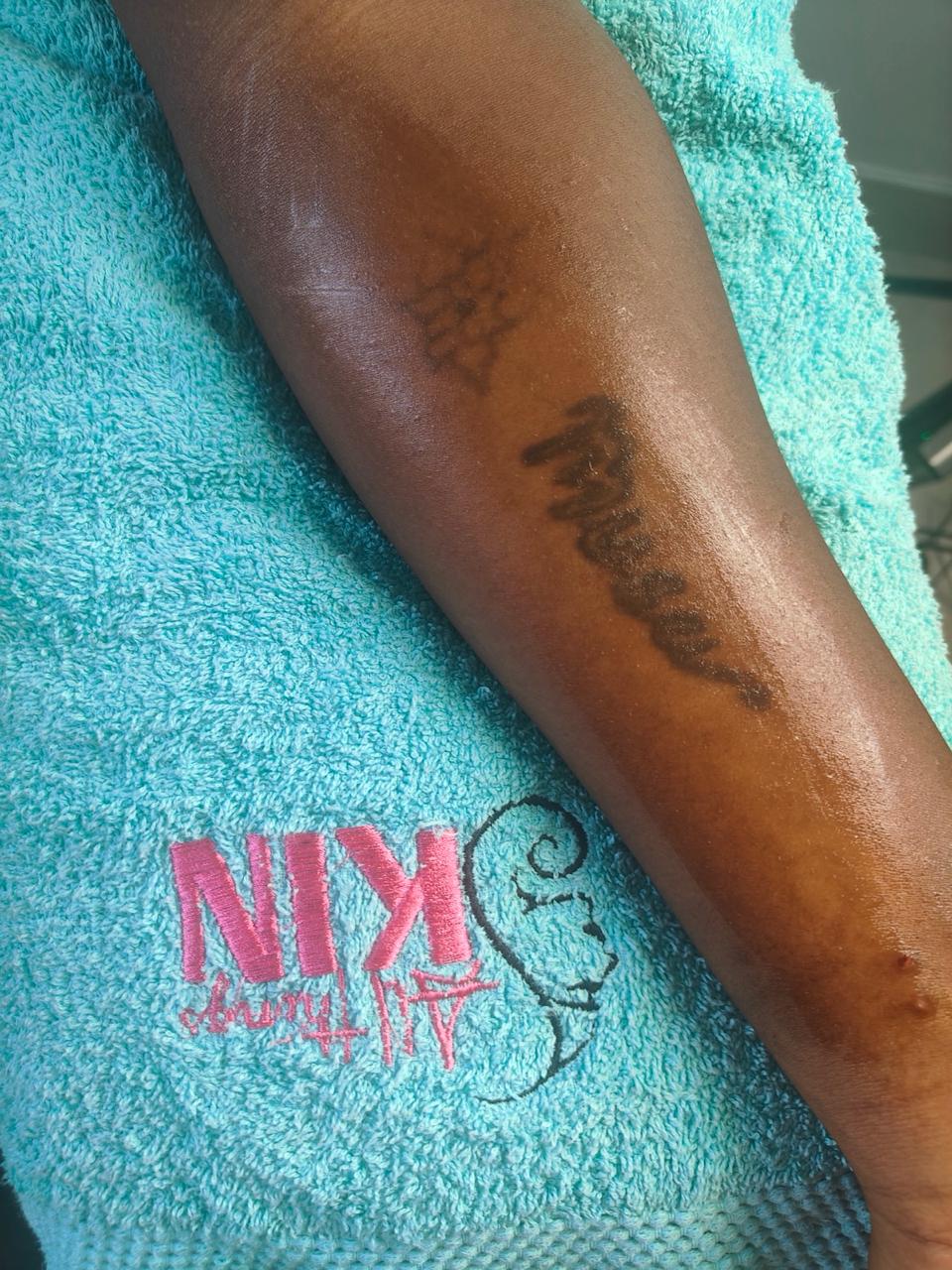 Tattoo removal treatment on a forearm