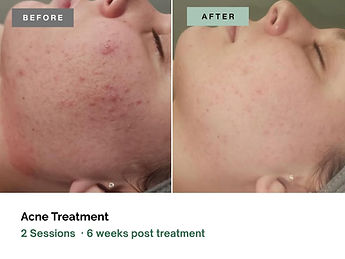 Procell-Acne-Oviedo.jpg