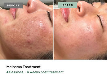 Procell-Acne-Oviedo.jpg